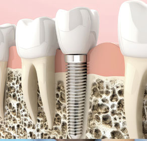 Osteointegración